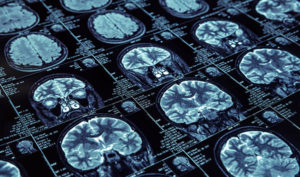 Do you need a brain injury lawyer?