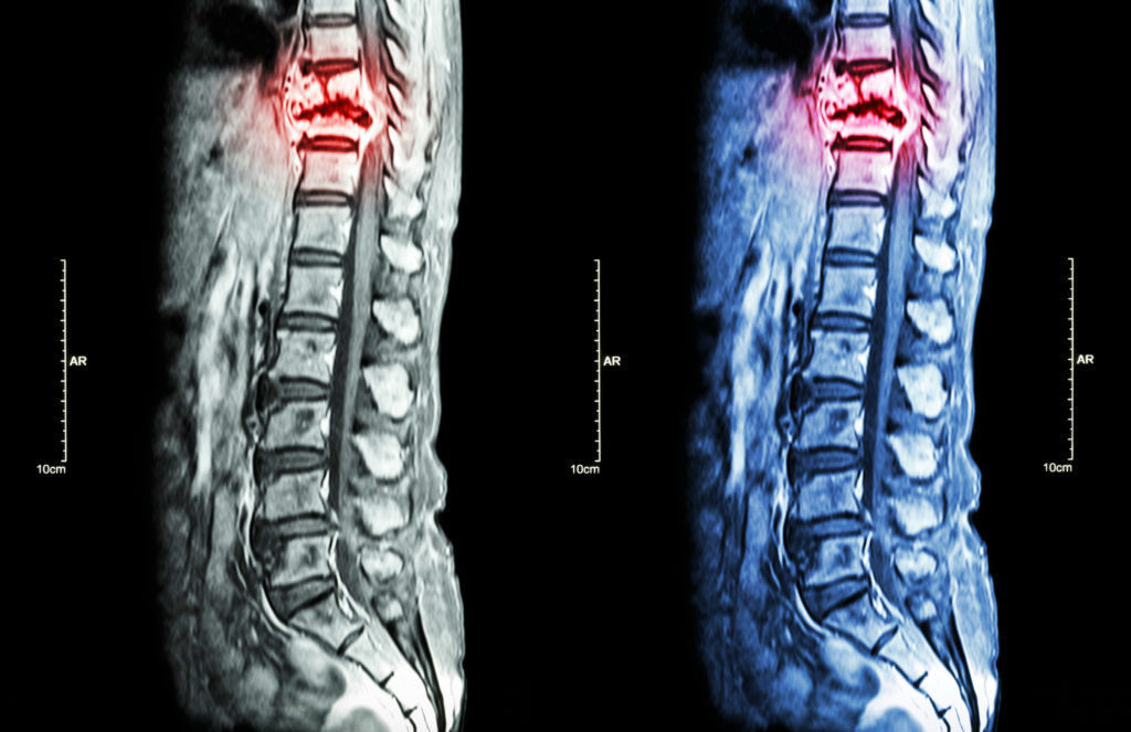 Spinal Cord Injuries Cirignani Heller Harman LLP