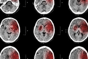 Subarachnoid Hemorrhage - What You Need to Know