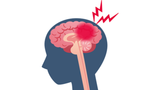 Brain Bleed Injuries