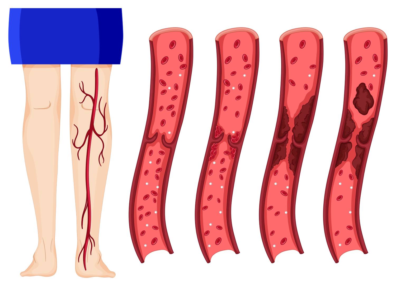 diagram of blood clots in the leg and how they form