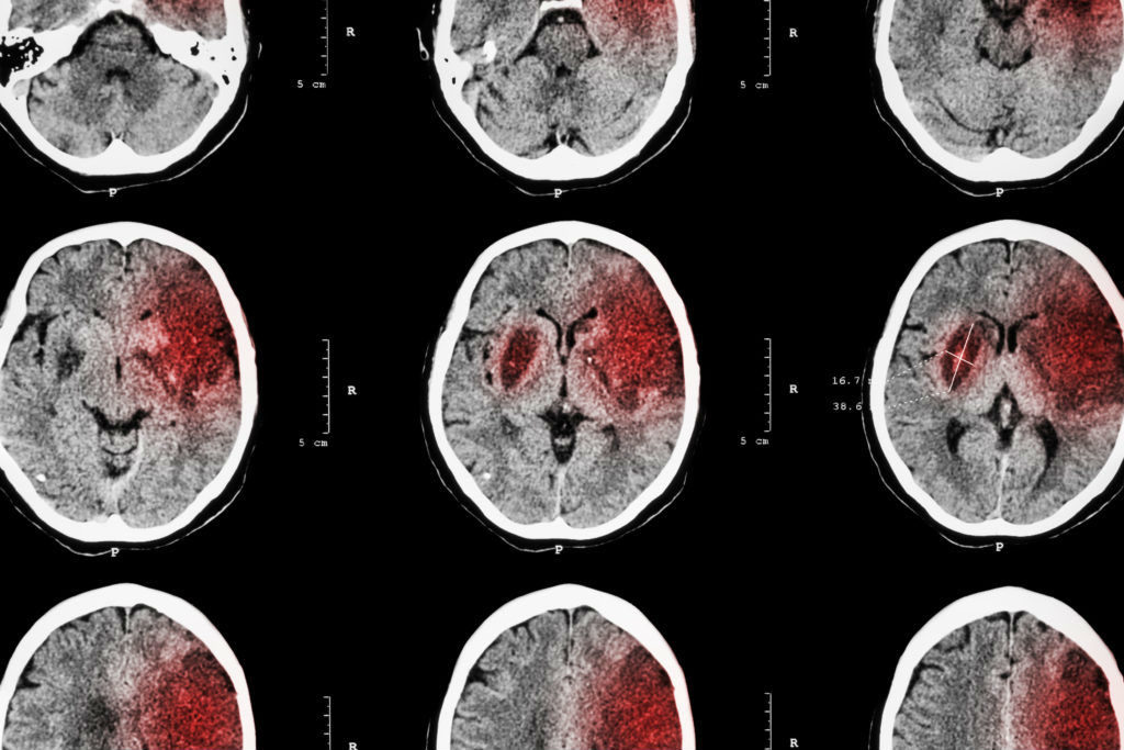 Missed Brain Hemorrhage Cirignani Heller Harman Llp - 