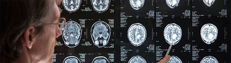 Brain Injuries