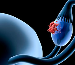 i-diagnosingandtreatingovarian