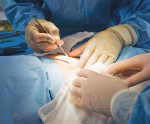Surgical Errors