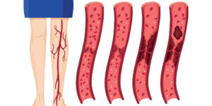 Blood Clot Patient Safety Tips